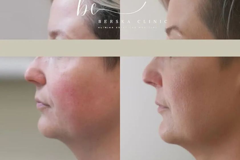 Antiaging před a po - 859343