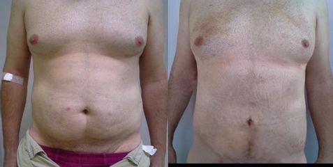 Liposukce
