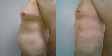 Liposukce