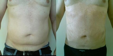Liposukce