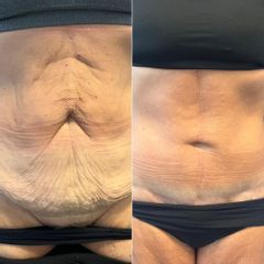 Abdominoplastika FDL