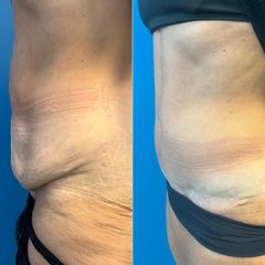 Abdominoplastika FDL