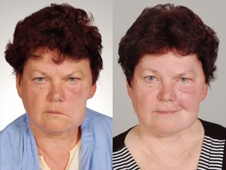 Chirurgická rekonstrukce obličeje - 734229