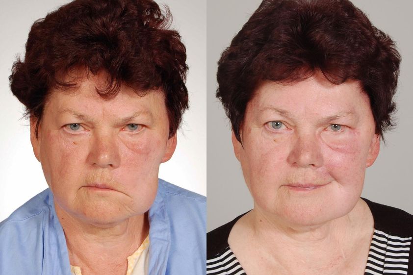 Chirurgická rekonstrukce obličeje před a po - 734229