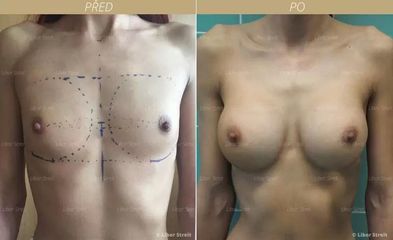 BEFORE augmentace zvetseni prsou implantaty