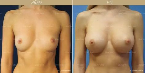 BEFORE augmentace zvetseni prsou implantaty pred po