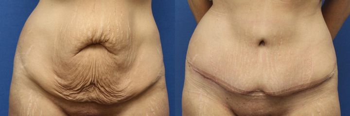 Abdominoplastika (operace břicha)