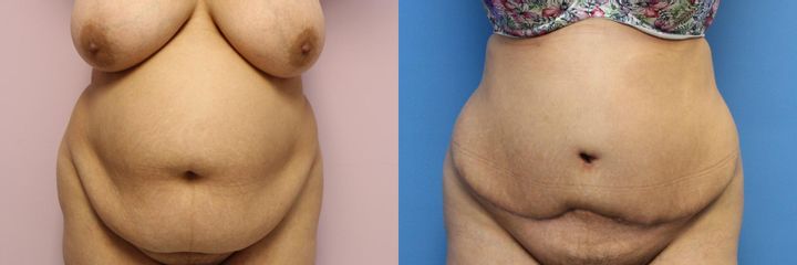 Abdominoplastika (operace břicha)