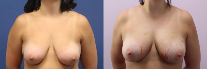 Zvětšení prsou vlastním tukem – lipografting přístrojem Body-jet – foceno týden po zákroku