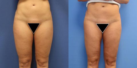 Liposukce pomocí přístroje Body-jet – oblast vnější stehna