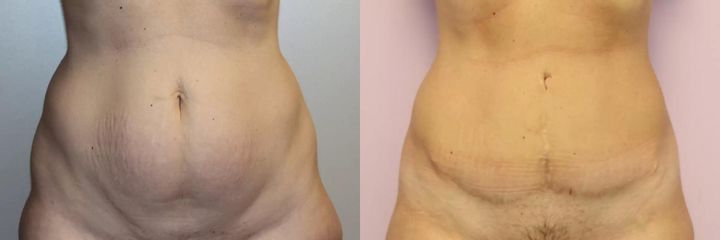 Abdominoplastika (operace břicha)