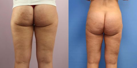 Liposukce pomocí přístroje Body-jet – oblast vnější stehna
