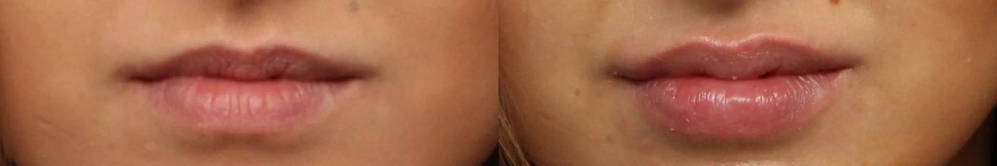 Stylage special lips mepivacaine