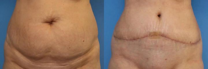 Abdominoplastika (operace břicha)