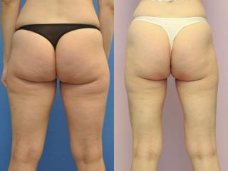 Liposukce pomocí přístroje Body-jet – oblast vnější a vnitřní stehna