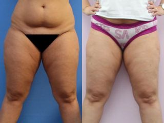 Liposukce pomocí přístroje Body-jet – oblast vnější stehna