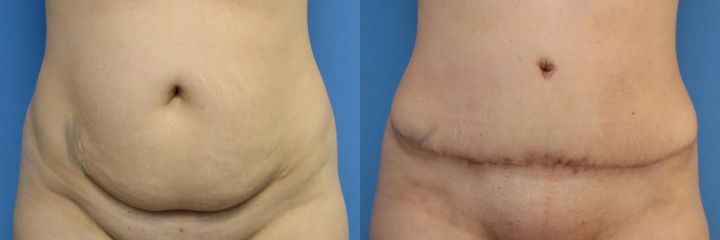 Abdominoplastika (operace břicha)