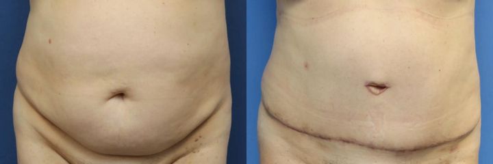 Abdominoplastika (operace břicha)