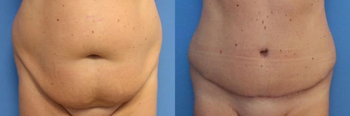 AbdominoplastikaAbdominoplastika (operace břicha)