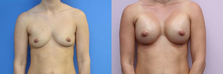 Foceno 9 dní od zákroku, Motiva ergonomix P 375 ml, L 355 ml