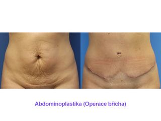 Abdominoplastika (Operace břicha)
