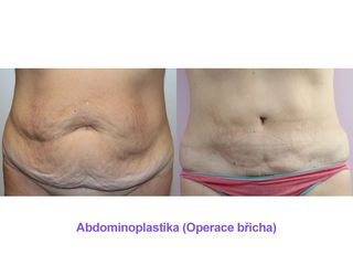 Abdominoplastika (Operace břicha)