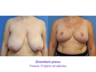 Zmenšení prsou