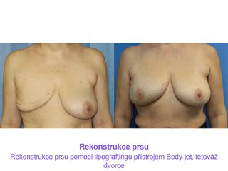 Rekonstrukce prsu