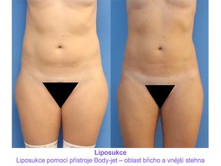 Liposukce