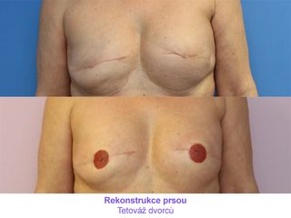 Rekonstrukce prsou