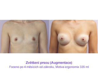 Zvětšení prsou (Augmentace)