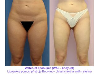 Water-jet liposukce (WAL - body-jet)