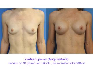 Zvětšení prsou (Augmentace)