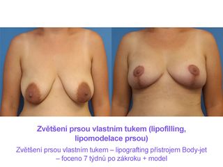 Zvětšení prsou vlastním tukem