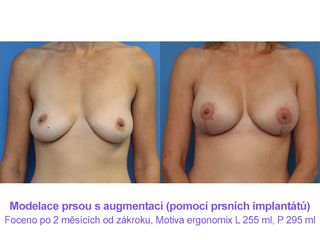 Modelace prsou s augmentací