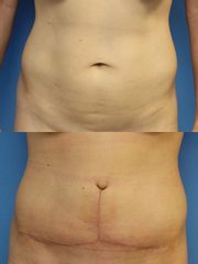 Abdominoplastika (Operace břicha)