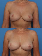 Lipofilling - přenos a aplikace vlastního tuku