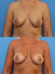 Lipofilling - přenos a aplikace vlastního tuku