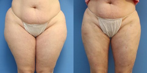 Liposukce - MUDr. Jiřina Šilhánková