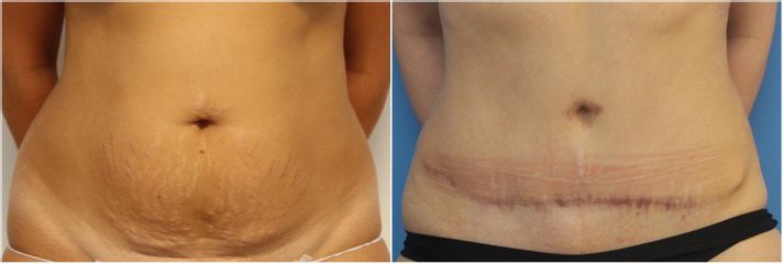Abdominoplastika - MUDr. Jiřina Šilhánková