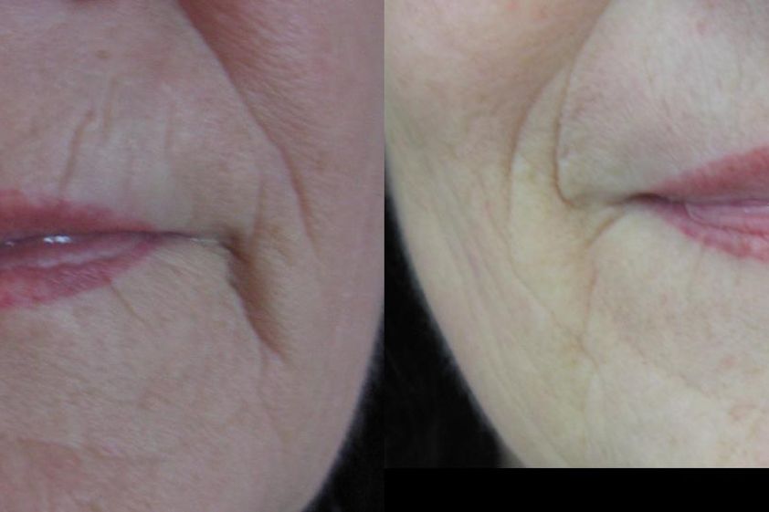 Microneedling před a po - 728240