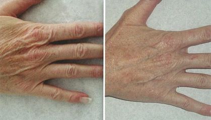 peeling b