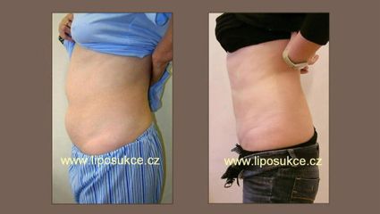 LIPOSUKCE BŘICHA