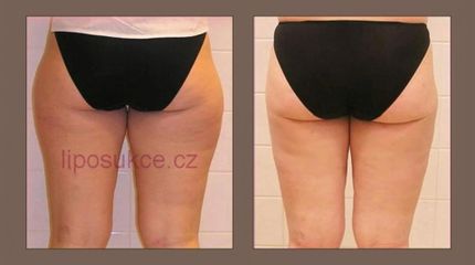 LIPOSUKCE ZEVNÍCH STEHEN