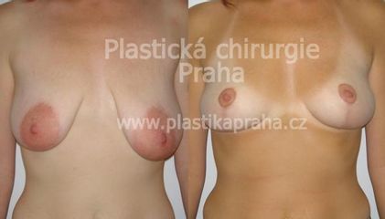 asymetrie prsa