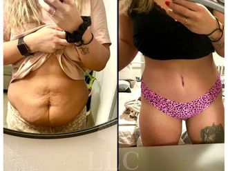 Abdominoplastika - 848992