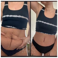 Abdominoplastika - prim. MUDr. Bronislav Vřeský