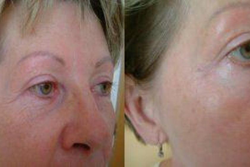 Fotorejuvenace IPL před a po - 722854