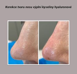 Nechirurgická korekce nosu - L centrum Pardubice