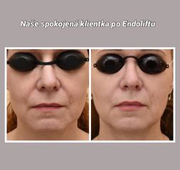 Injekční výplně - L centrum Pardubice